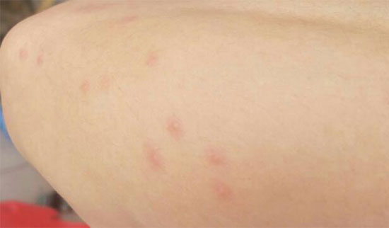 皮膚過敏最好的自愈方法,抗過敏針多少錢一針