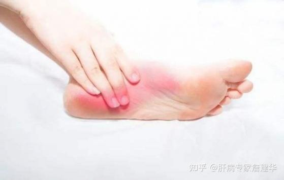 肝不好的人看腳就知道，肝不好的人看腳就知道不好