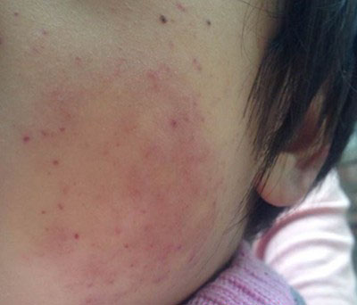 白血病的早期癥狀，白血病的早期癥狀和前兆圖片