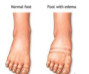 肝癌早期腳上有三個預兆,肝病腳上癥狀圖片