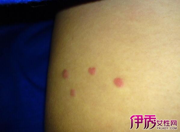 hiv初期淋巴腫大位置圖腿部（hiv初期淋巴腫大位置圖）