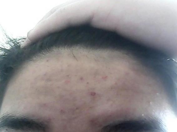 小弟外皮上面長了痘痘癢怎么回事（小弟外皮上面長了痘痘）