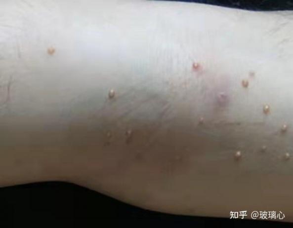 口腔感染hpv有什么癥狀（感染hpv有什么癥狀）