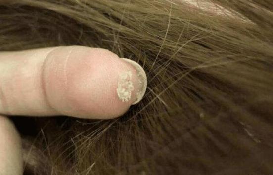 兒童頭皮癬怎么治才能除根（頭皮癬怎么治才能除根）