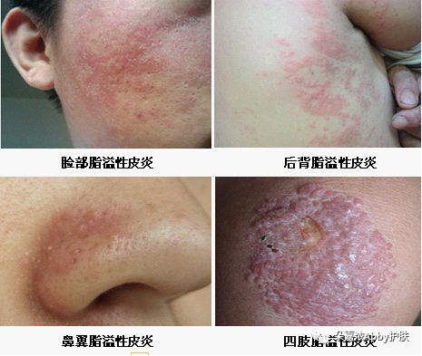 常見的濕疹圖片大全(常見濕疹分為五種類型圖片)