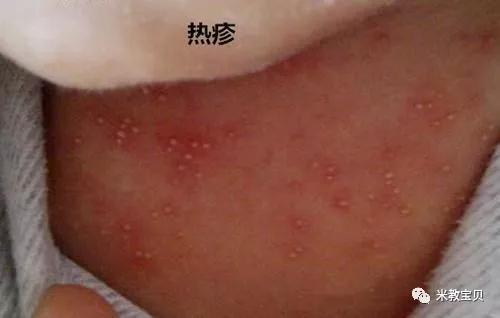 濕疹和熱疹的區(qū)別圖片一目了然媽媽切記病急亂投醫(yī)（熱疹和濕疹的圖片）