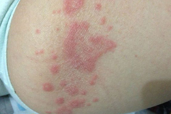 大腿紅斑圖片和癥狀圖片（紅斑圖片和癥狀圖片）