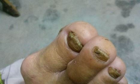 大腳趾嚴(yán)重灰指甲圖片女(大腳趾嚴(yán)重灰指甲圖片)