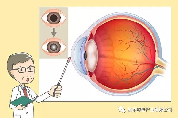 白內障早期最佳治療方法白內障手術要住院嗎(白內障早期最佳治療方法)