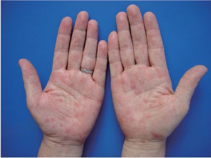 女性硬下疳是什么樣子手部（女性硬下疳是什么樣子）