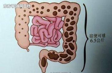 十秒快速催大便的動作（怎樣治便秘最快最有效的方法）