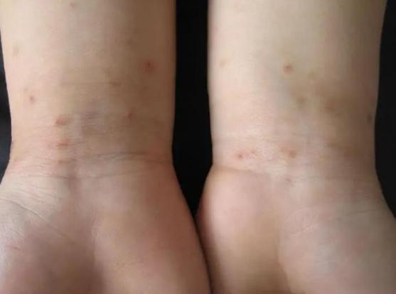 疥瘡早期癥狀圖片介紹（疥瘡初期癥狀圖片）