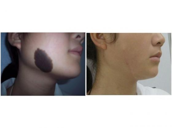 黑色素痣有必要切除嗎圖片(黑色素痣有必要切除嗎)