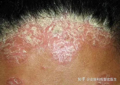 銀屑病頭皮上會自愈嗎（輕度頭部銀屑病圖片）