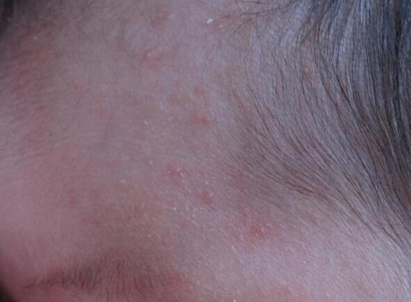 新生兒濕疹和熱疹圖片對照（濕疹和熱疹圖片對照）