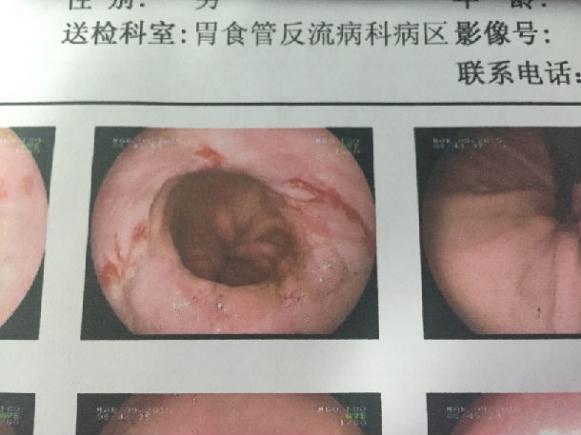 反流性食管炎10種癥狀能自愈（反流性食管炎10種癥狀）