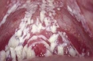 霉菌和滴蟲的區別圖片（霉菌性陰炎嚴重后果）