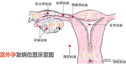 宮外孕腹部疼痛位置圖片（宮外孕腹痛位置圖片）