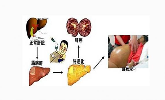 乙肝早期會(huì)有什么癥狀（乙肝早期可能有6個(gè)征兆）