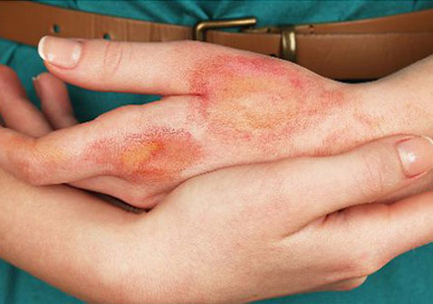 神經(jīng)性皮炎怎么根治(神經(jīng)性皮炎怎么根治簡單技巧)