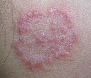 神經皮炎照片真實圖片（神經性皮炎的癥狀圖片）