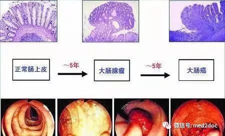 十個做胃鏡九個有息肉息肉活檢要多長時間出結果(十個做胃鏡九個有息肉)