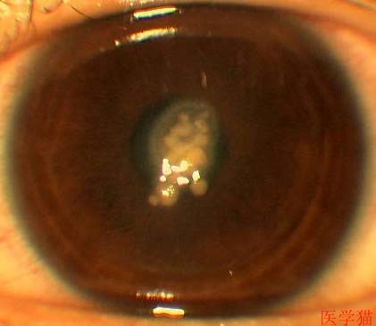 單純皰疹病毒性角膜炎癥狀（角膜炎癥狀）