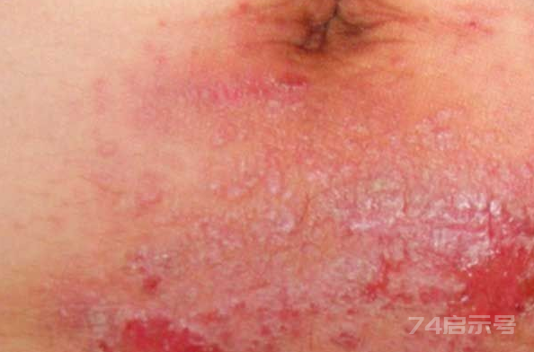 常見的皮膚病圖解（常見的皮膚病癥狀以及圖片）