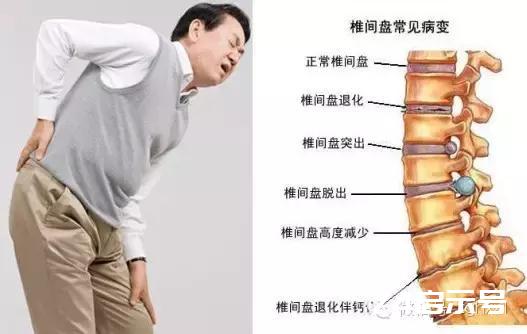 怎樣判斷腰肌勞損還是腰間盤突出需要住院嗎（怎樣判斷腰肌勞損還是腰間盤突出）