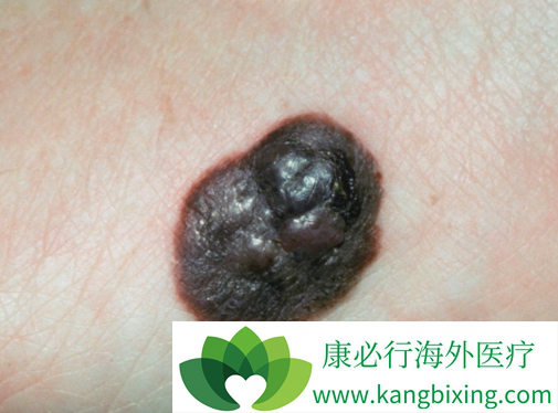 腳底黑色素瘤能活多久（黑色素瘤能活多久）