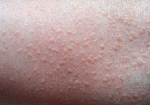 腳上皮膚病種類對照圖片（皮膚病種類對照圖片）