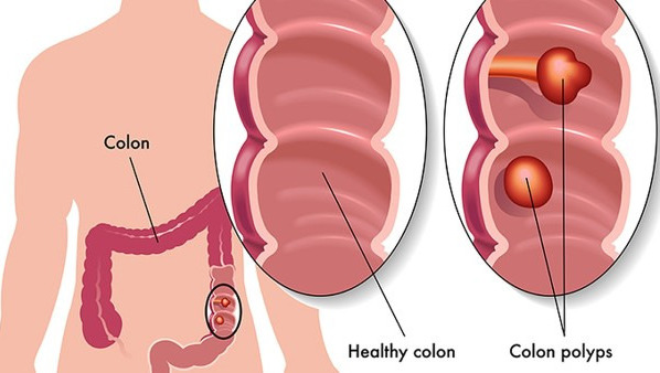 什么人容易得結(jié)腸癌（結(jié)腸炎是怎么形成的）