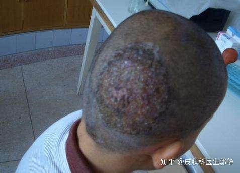 頭癬的癥狀和治療方法(頭癬用什么藥膏最好)