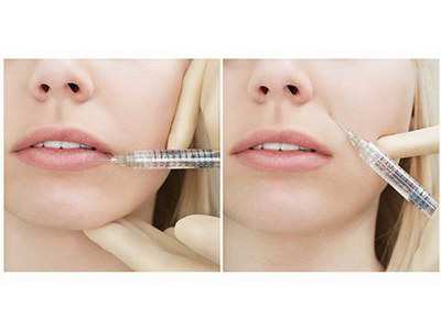 膠原蛋白打一針大概多少錢啊（膠原蛋白注射費用）