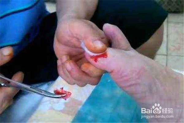 灰指甲怎么治療除根（灰指甲怎么治療除根需要多長時間）