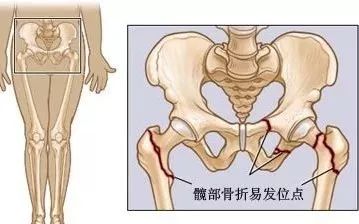 骨頭壞死了還能恢復(fù)嗎（骨頭壞死了還能恢復(fù)嗎中醫(yī)）