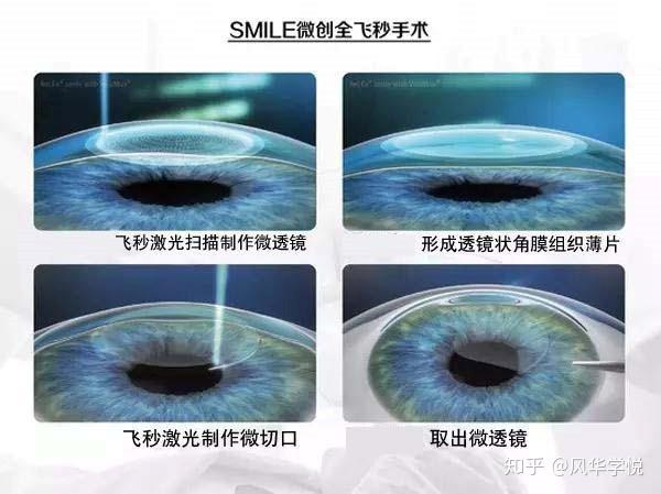 眼睛激光手術大概需要多少錢(眼睛激光手術大概需要多少錢一次)