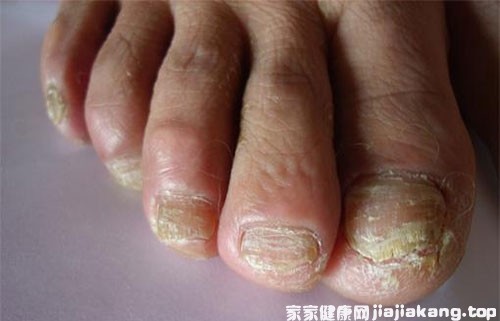 腳氣真菌感染用哪些藥最好（腳氣真菌感染吃什么藥最好）