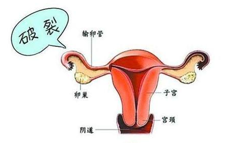 什么人容易得宮外孕（宮外孕）