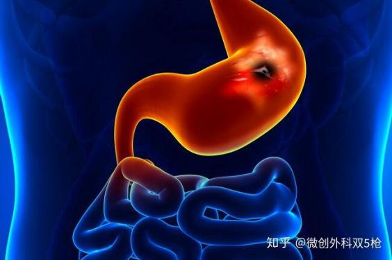 4月胃鏡正常10月胃癌（4月胃鏡正常10月胃癌可能性大嗎）