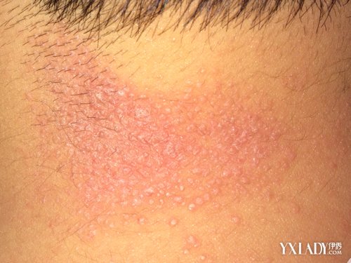 神經性皮炎怎么除根(頑固神經性皮炎怎么除根)