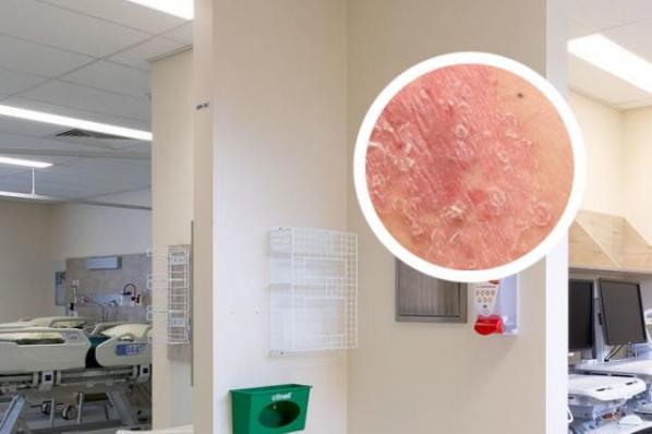 銀屑病的克星白醋（銀屑病的克星白醋自愈）