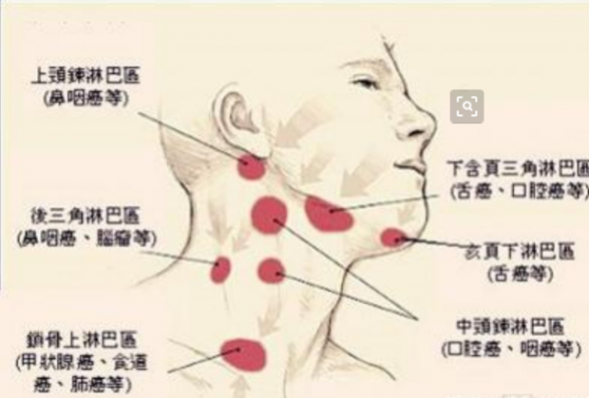 淋巴結腫大癥狀（淋巴結腫大癥狀會疼嗎）