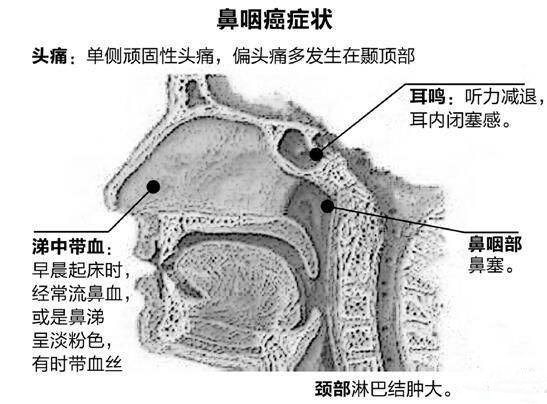 鼻咽癌的早期癥狀和前兆(鼻咽癌前期的18種預兆)