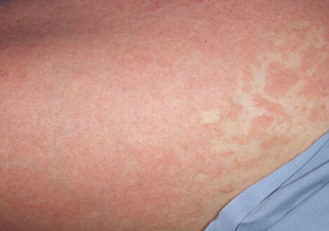 牛皮皮癬早期怎么控制（牛皮皮癬早期怎么控制北京仲博中醫(yī)醫(yī)院好不好）