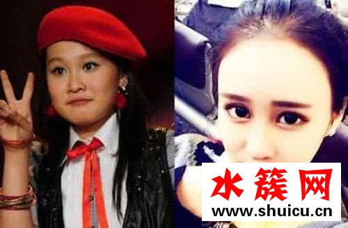 趙本山女兒球球承認整容