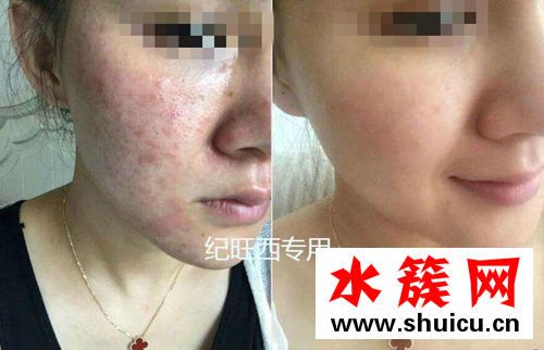 激素臉自己可以好嗎 究竟激素臉怎樣治療好的快